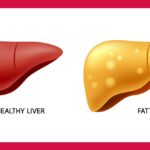 کبد چرب